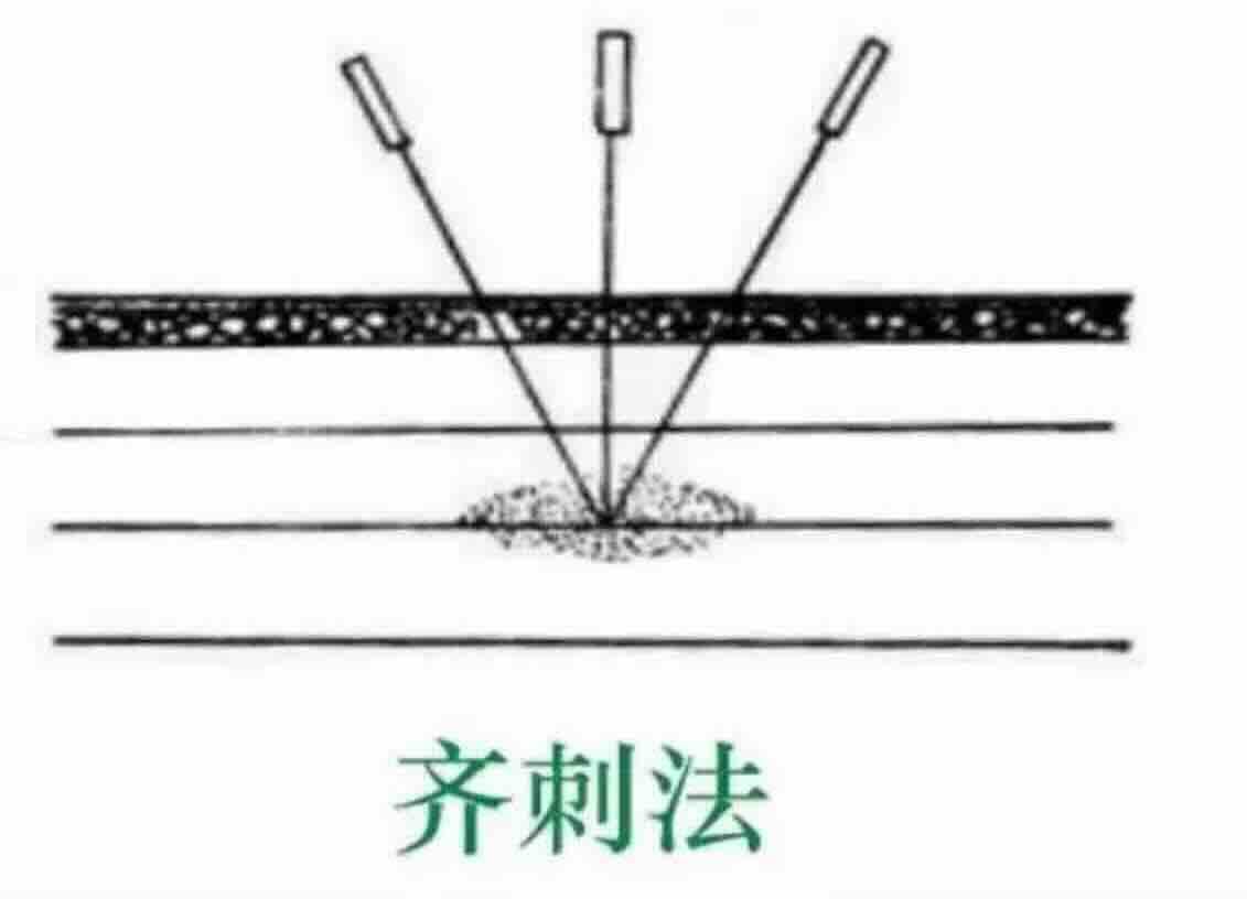《内经》五体治痛刺法映射表