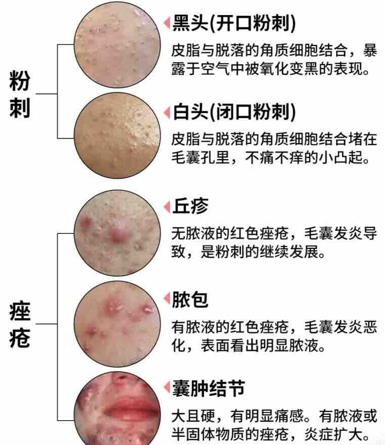 痤疮（青春痘/粉刺）针灸诊疗方案